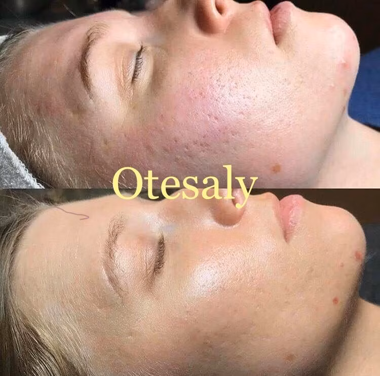 Medical Beauty Otesaly Collagen Lift Serum 5 Bottles 5ml Skin Therapy Stem Cell Tightens Skin Lightens Dark Circles Eye Bags