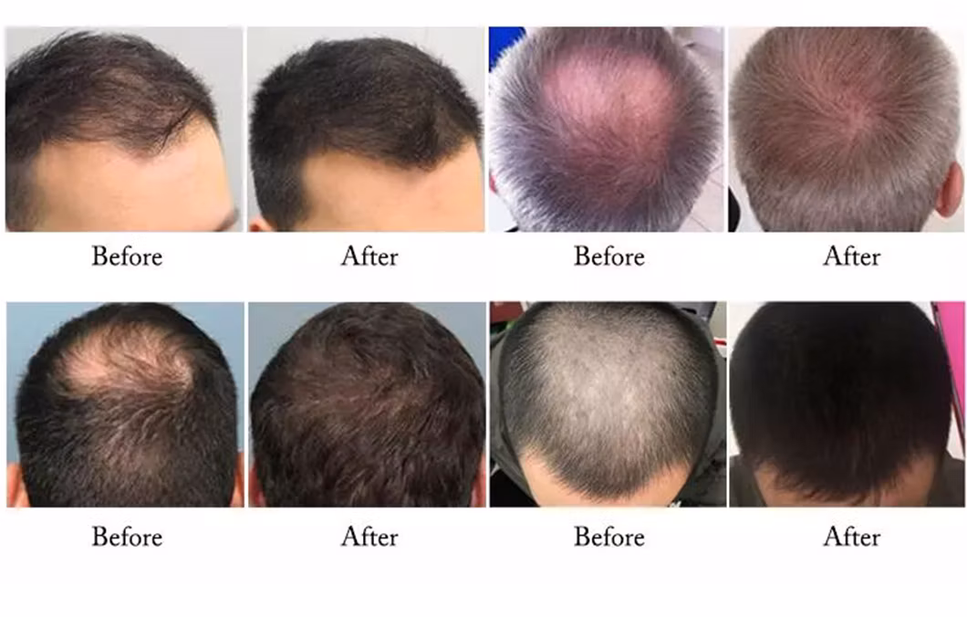 Stimulation of Epidermal Stem Cells The Hair Follicle Laser Hair Growth Massager