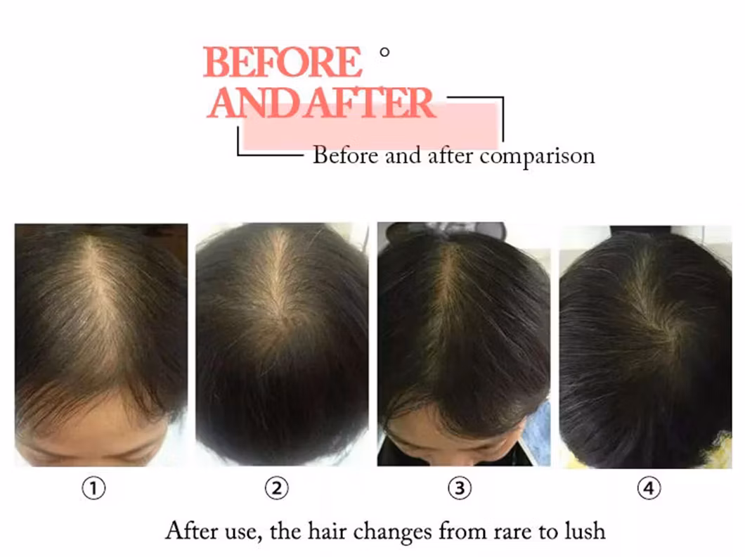 Stimulation of Epidermal Stem Cells The Hair Follicle Laser Hair Growth Massager