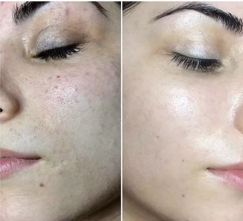 Mesotherapy Cellulite Fine Lines Removal Serum Non Cross Linked Hyaluronic Acid Solution Meso Whitening Solution