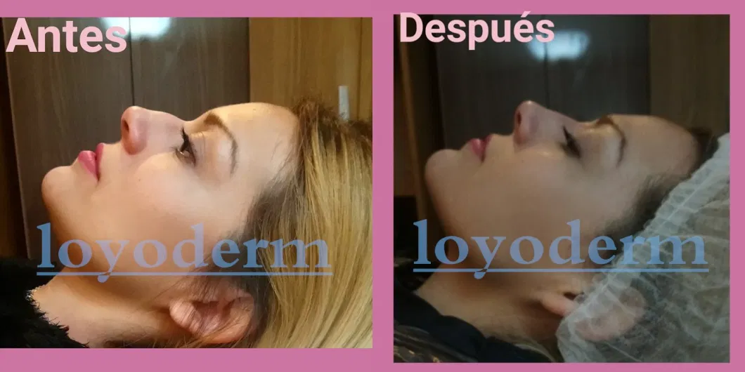 Hyalyronic Acid Injection Lips Dermal Filler Used by Hyaluron Pen