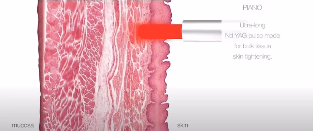4D PRO System Smooth Liftin Skin Resurfacing Laser 2940 Nm Erbium YAG+1064 Nm ND: YAG Laser Device