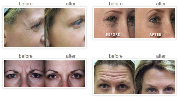 Disposable Cross Linked Hyaluronic Gel Ha Dermal Fillers