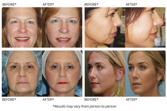 Disposable Cross Linked Hyaluronic Gel Ha Dermal Fillers