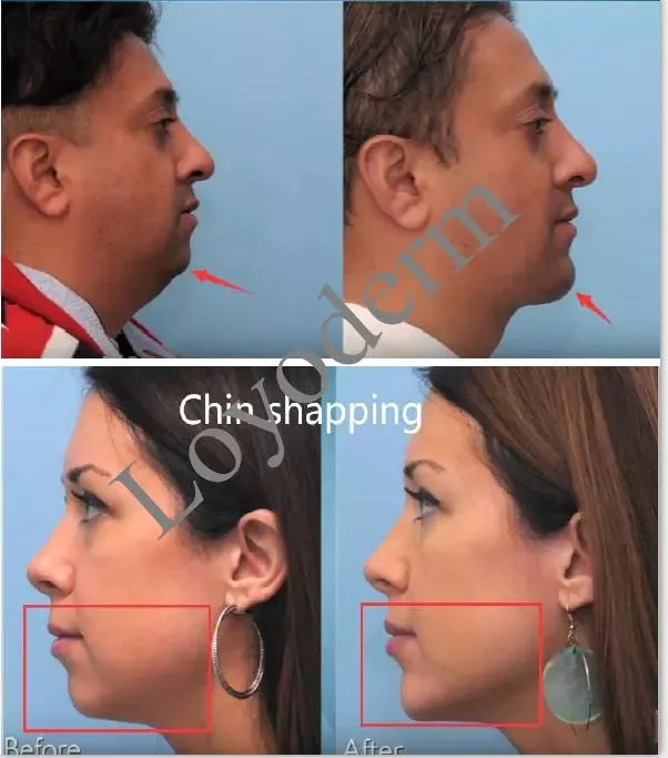 Disposable Cross Linked Hyaluronic Gel Ha Dermal Fillers