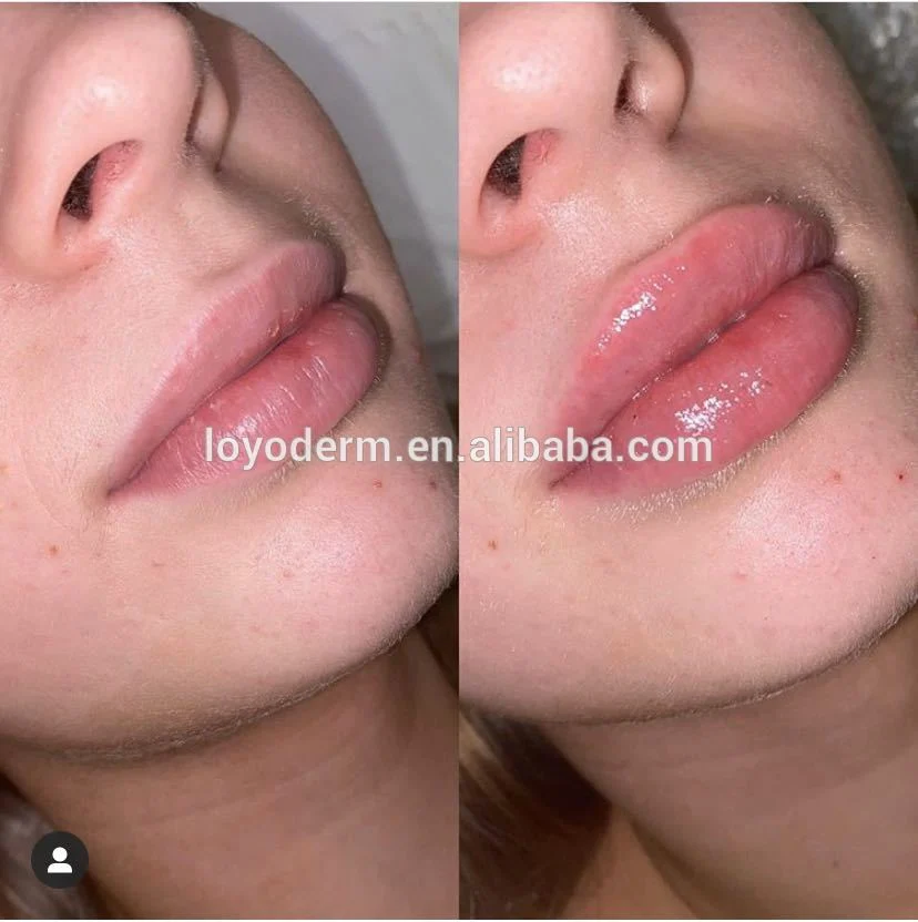 Disposable Cross Linked Hyaluronic Gel Ha Dermal Fillers