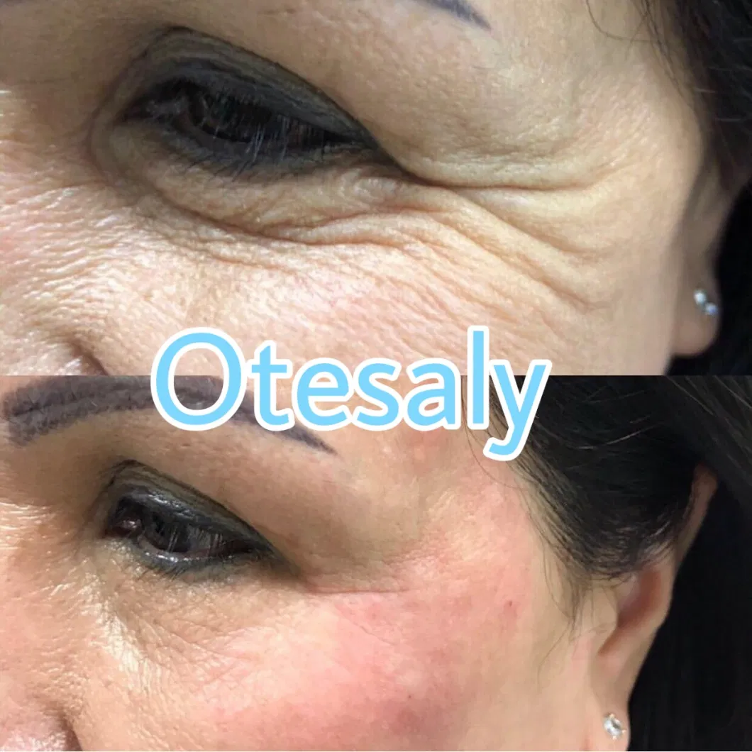 China Supply Remove Nasolabial Wrinkles Non Animal Dermal Filler Otesaly Price Deep Lines Filler