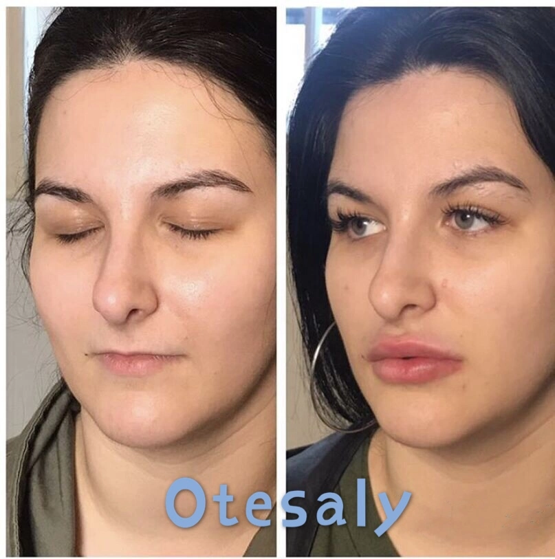 CE Certified Otesaly Injectable Cross Linked Cheek Lip Hyaluronic Acid Filler Non-Animal Dermal Filler Injections