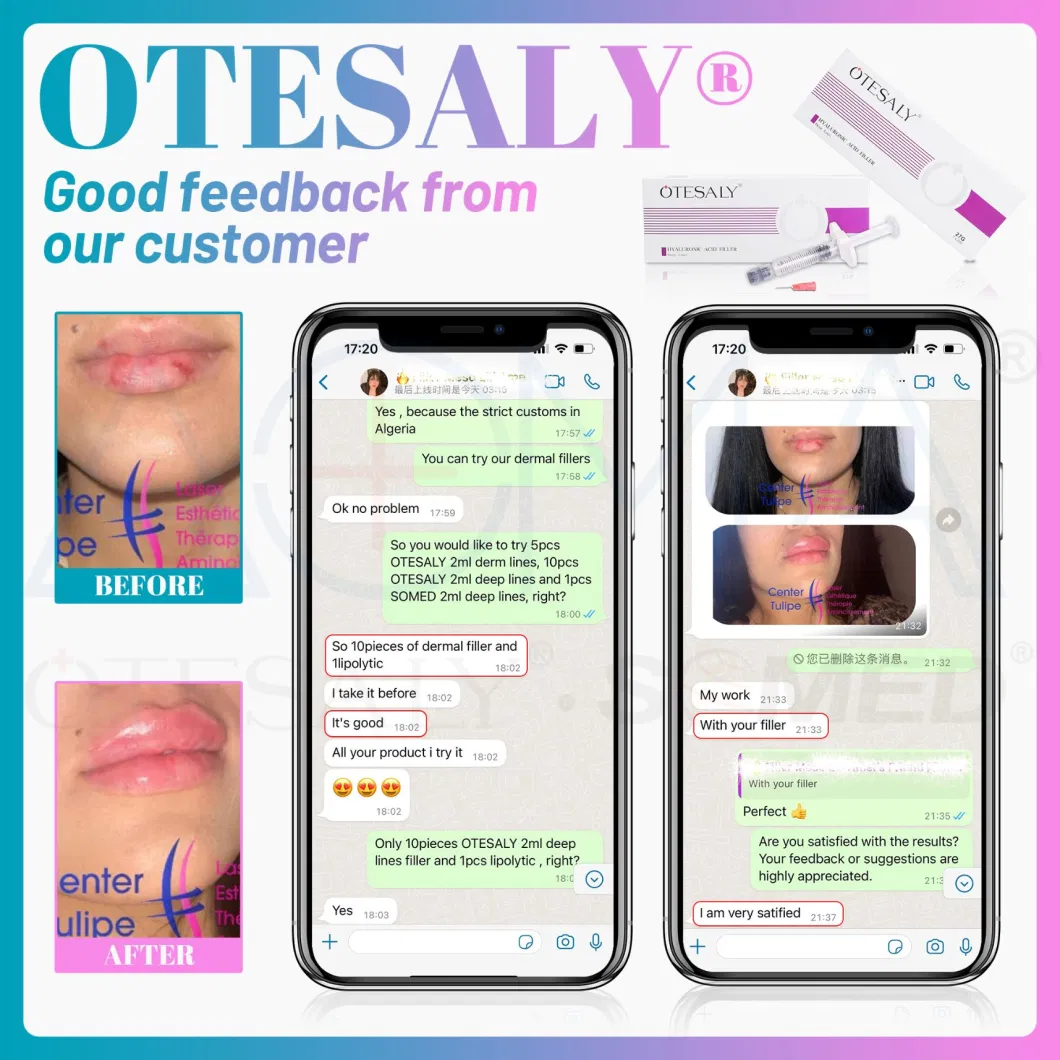 CE ISO13485 Certified Otesaly 2ml Cross Linked Hyaluronic Acid Injectable Gel Injection Lip Augmentation Korea Dermal Filler