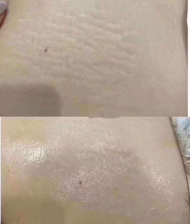 Korean Yimeiqi Gestational Stria Cell Culture Solution Sleeve Box Desalination of Acne Marks and Pits Obese Stria Electric Micro Needle Household