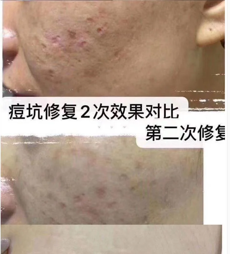 Korean Yimeiqi Gestational Stria Cell Culture Solution Sleeve Box Desalination of Acne Marks and Pits Obese Stria Electric Micro Needle Household