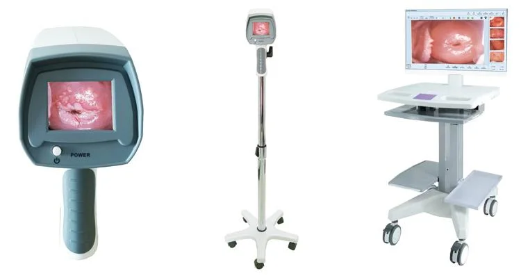 Gynecologist Clinic Hospital Use Video Colposcope for Gynecology