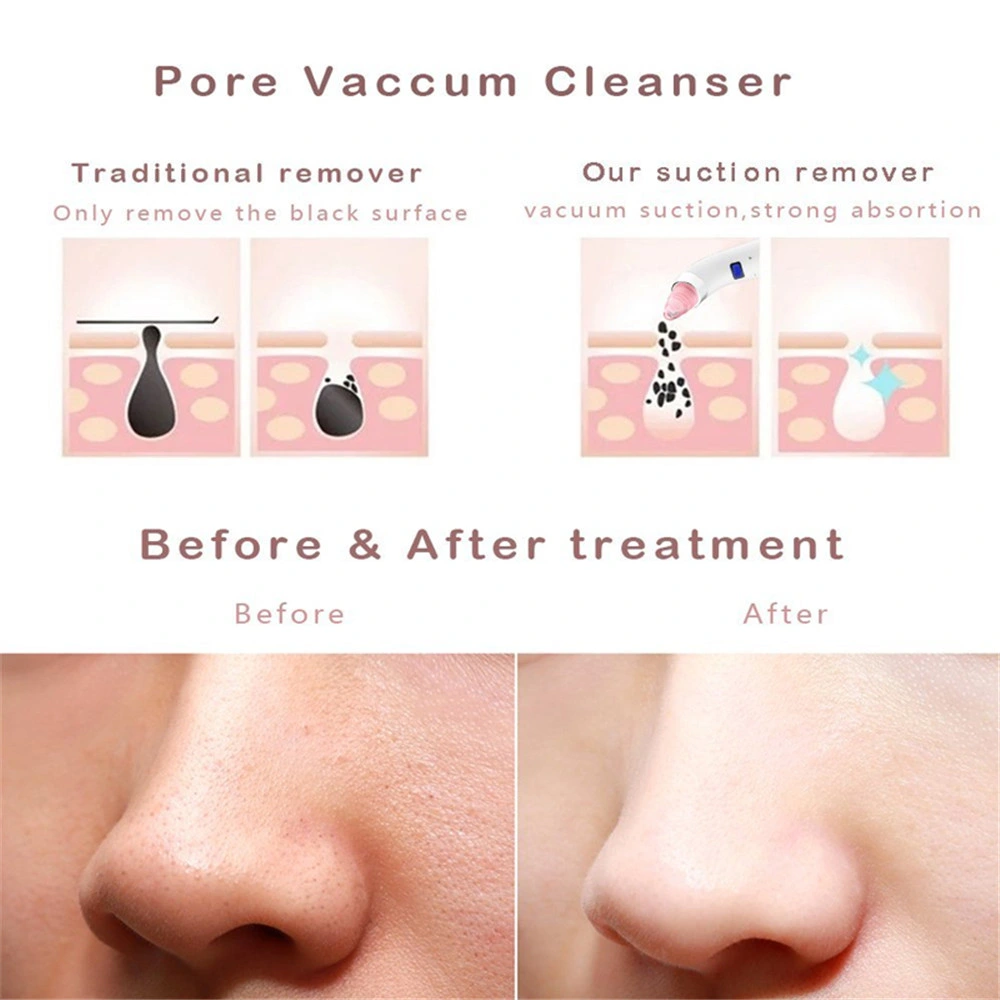 Beauty Product Skin Cleaning Nose Blackhead Remover