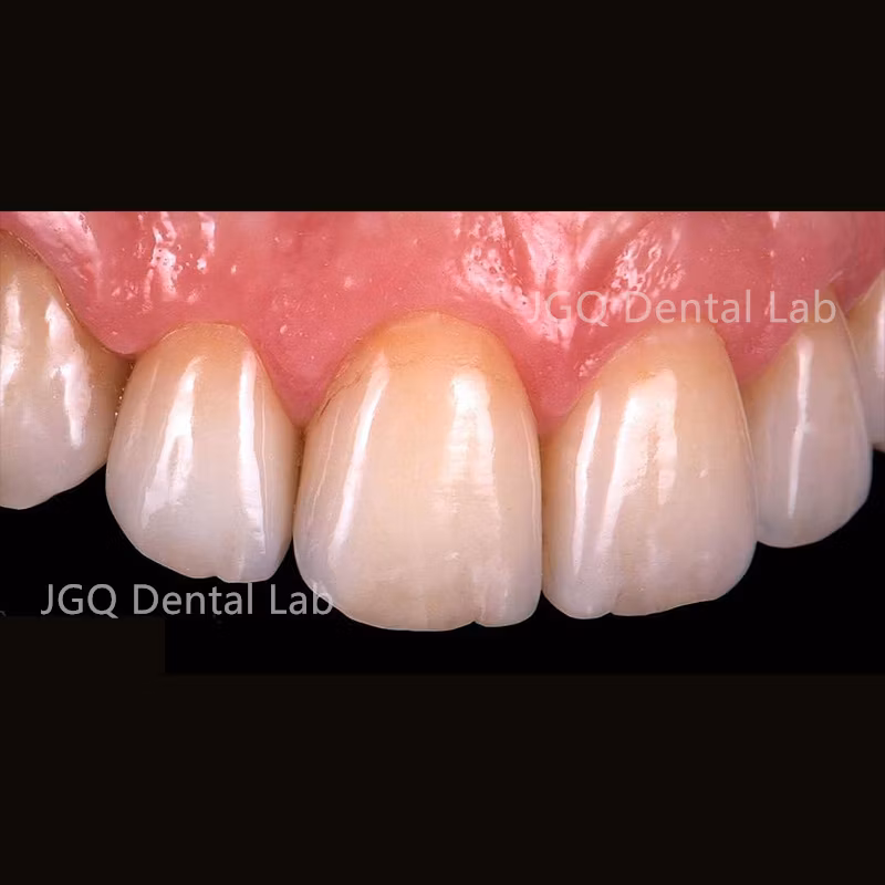 3D Printer Print Metal Crown Long-Span Pfm Dental Bridges with Porcelain Built up