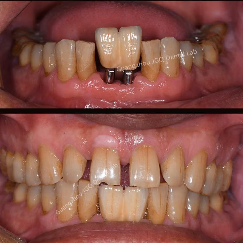 3D Printer Print Metal Crown Long-Span Pfm Dental Bridges with Porcelain Built up