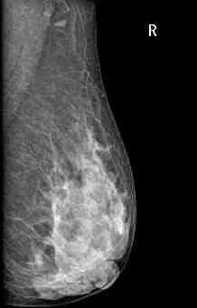 Mammography Device Foinoe X-Rays Digital Mammography Machine for Diagnosis Breast Cancer