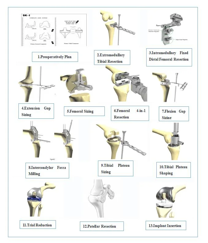 Manufacturer Revision Tka Total Knee Artificial Replacement Implants