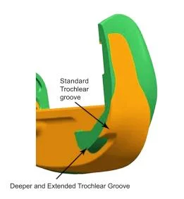 Manufacturer Revision Tka Total Knee Artificial Replacement Implants