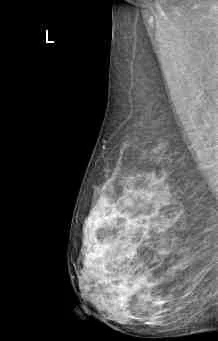 Digital Mammography for Breast Cancer Foinoe Mamografo Digital Medical X-ray Equipments &amp; Accessories