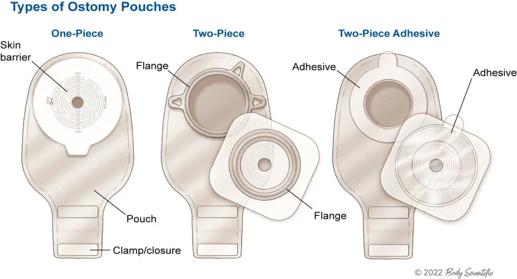 Medical Hospitals and Clinics Using Disposable One-Piece Drainable Pouch Hydrocolloid Colostomy Bag