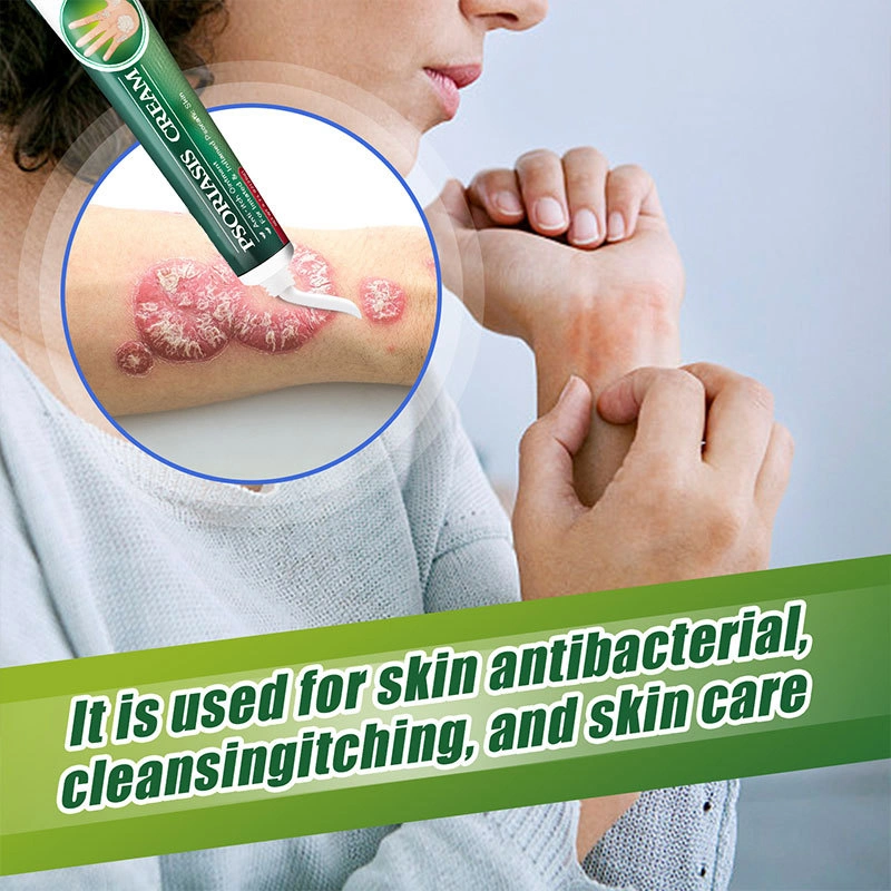 Hot Selling Fungal Infection Skin Psoriasis Creams Dermatitis Eczema Ointment Treatment Psoriasis Cream Skin Cream