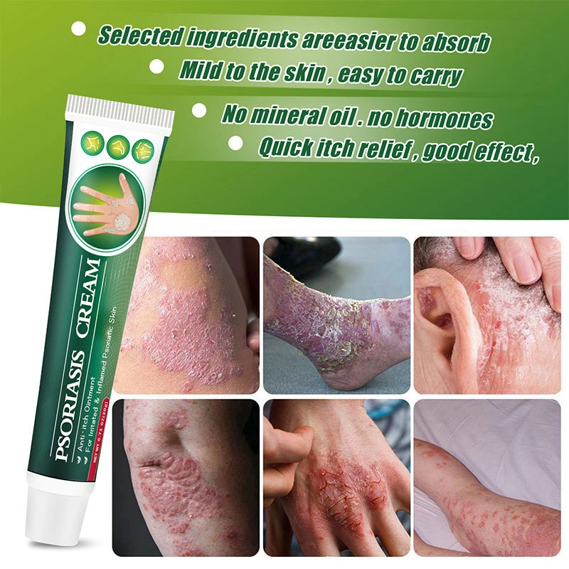 Hot Selling Fungal Infection Skin Psoriasis Creams Dermatitis Eczema Ointment Treatment Psoriasis Cream Skin Cream