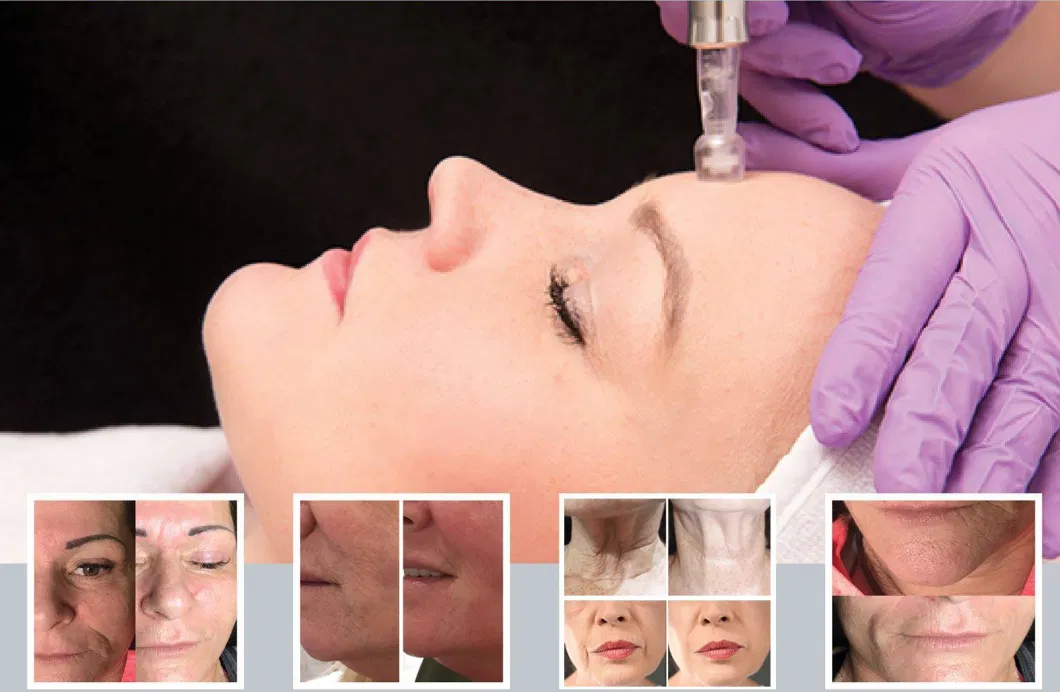 Tightening Meso Rejuvenating Skinwrinkle Removal Mesotherapy Collagen Injections Face Anti-Aging Serum