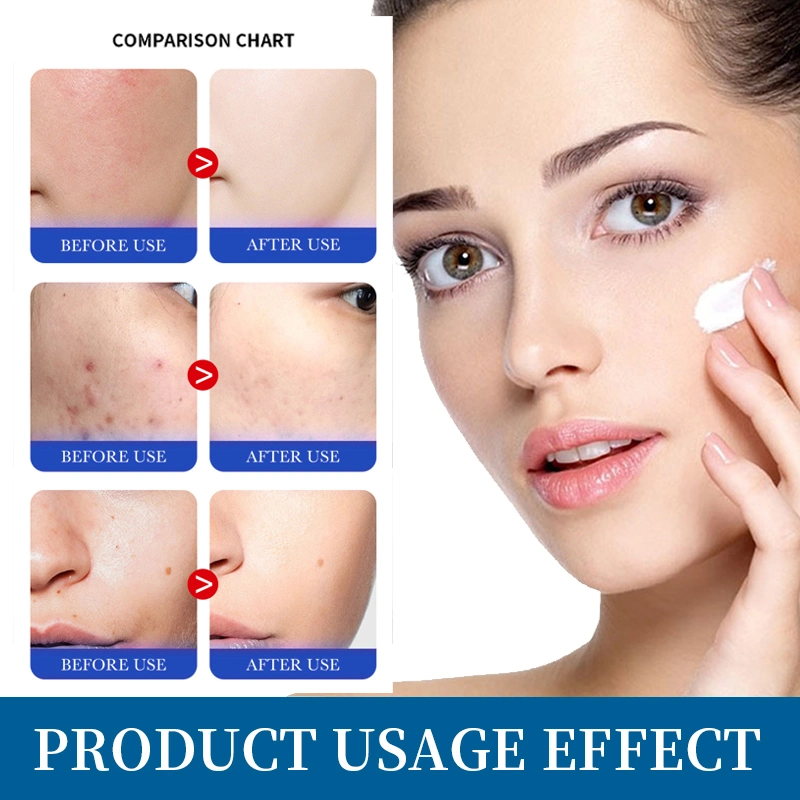 EGF 100% Natural Dispel Acne Cream Moisturize and Fade Acne Scars Essence