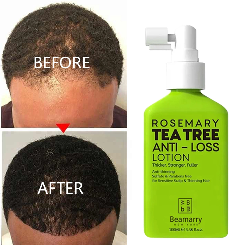 Private Label Tea Tree Oil Rosemary Anti-Loss Hair Growth Tonic