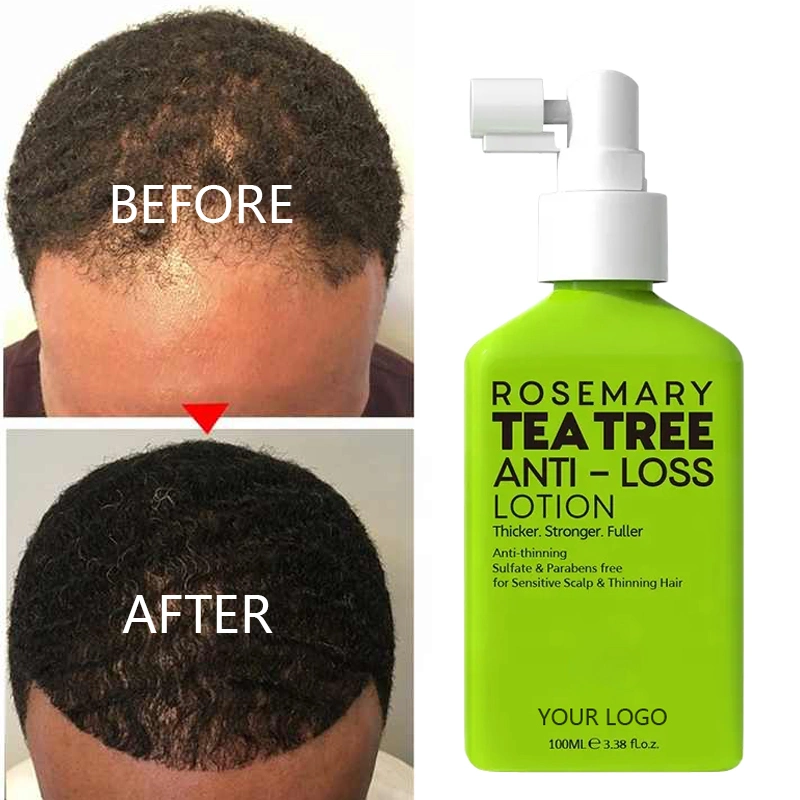 Anti Hair Loss Treatment Growth Serum Rosemary Tea Tree Energy Hair Tonic