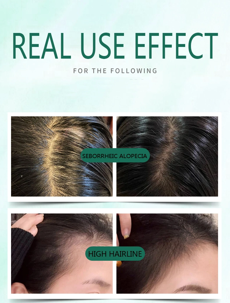 Anti-Hair Loss Follicle Nourish Hair to Protect Hair Growth Tonic