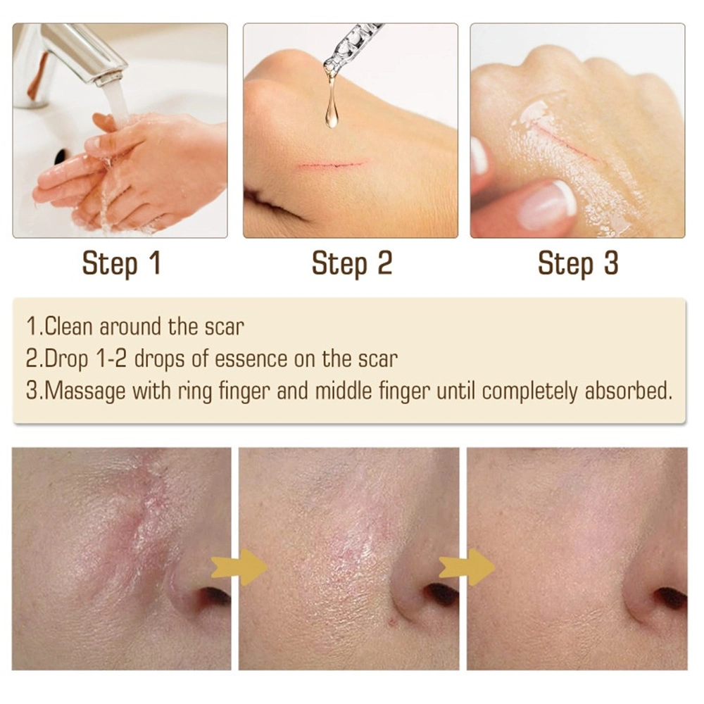 Noscarna Scar Removing Cream 20g Removing Acne Marks