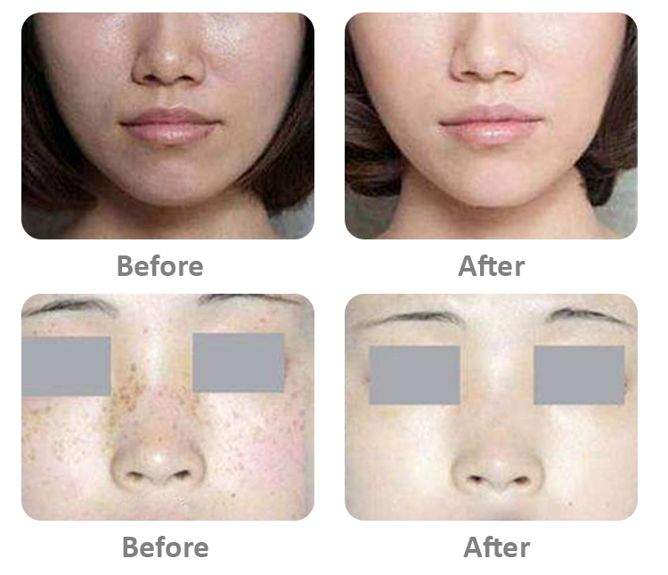 Korea Skin Lightening Luthione + Cinderella + Vitamin C Whitening Body Injections