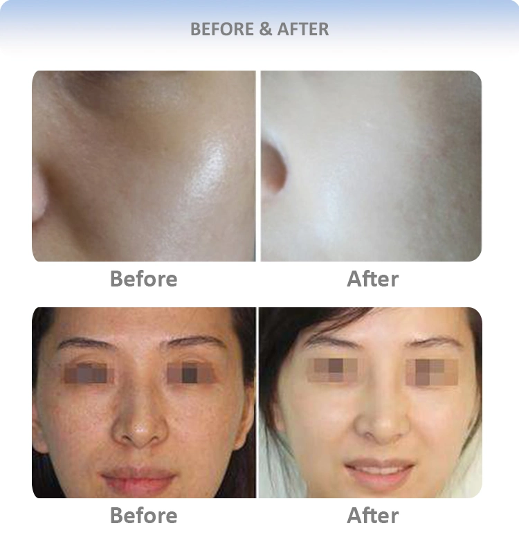 Skin Whitening Vitamin C Injection for Mesotherapy Solution Brightening Glutathione