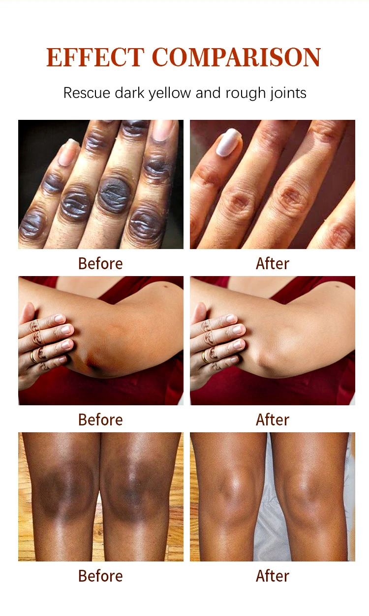 Mooyam Rapid Get Rid of Dark Hand Knuckle Whitening Serum Removing Dark Elbow Knees Clear Dark Knuckles Serum