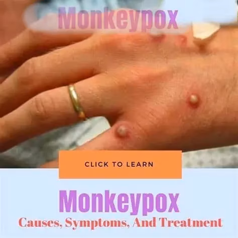 Ivd Monkey Pox Test Kit Monkeypox Rapid PCR Test Kit High Efficient Accuracy